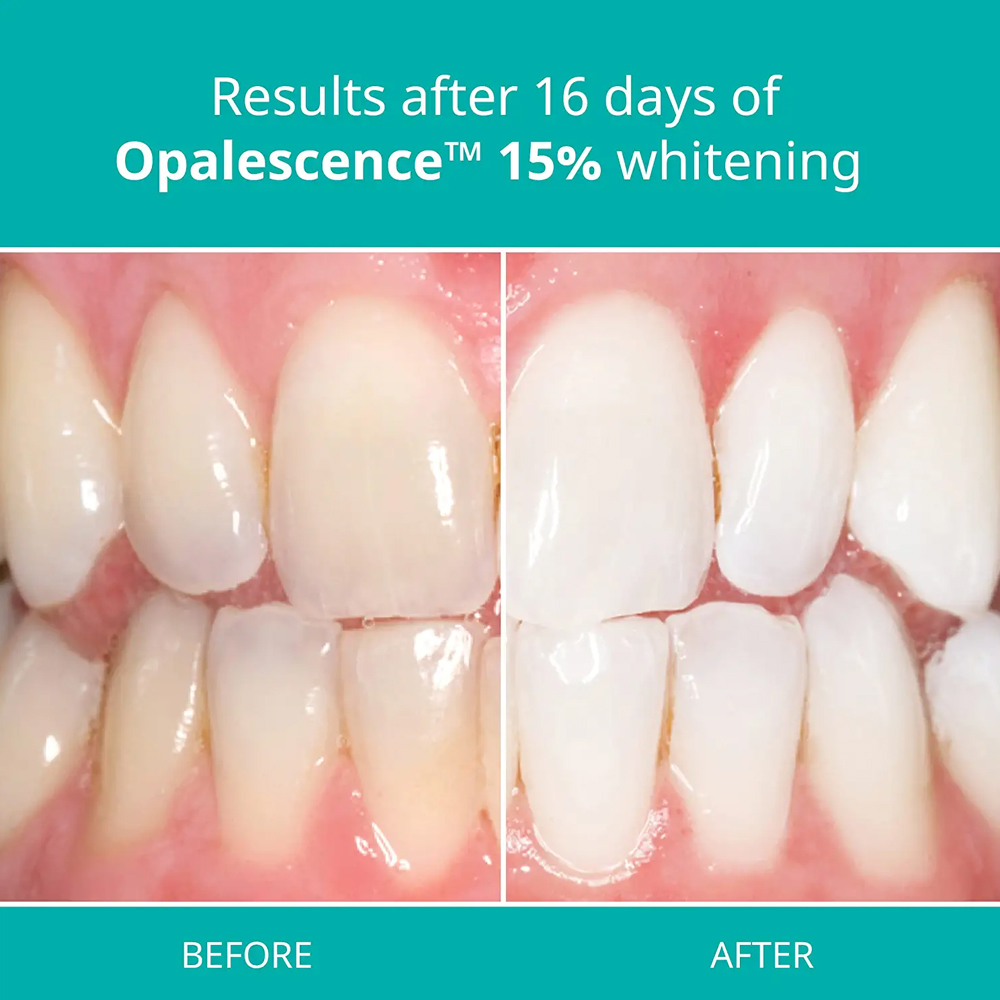 Teeth Whitening Gel Home Kit D - Teeth Whitening Gel Opalescence review and price