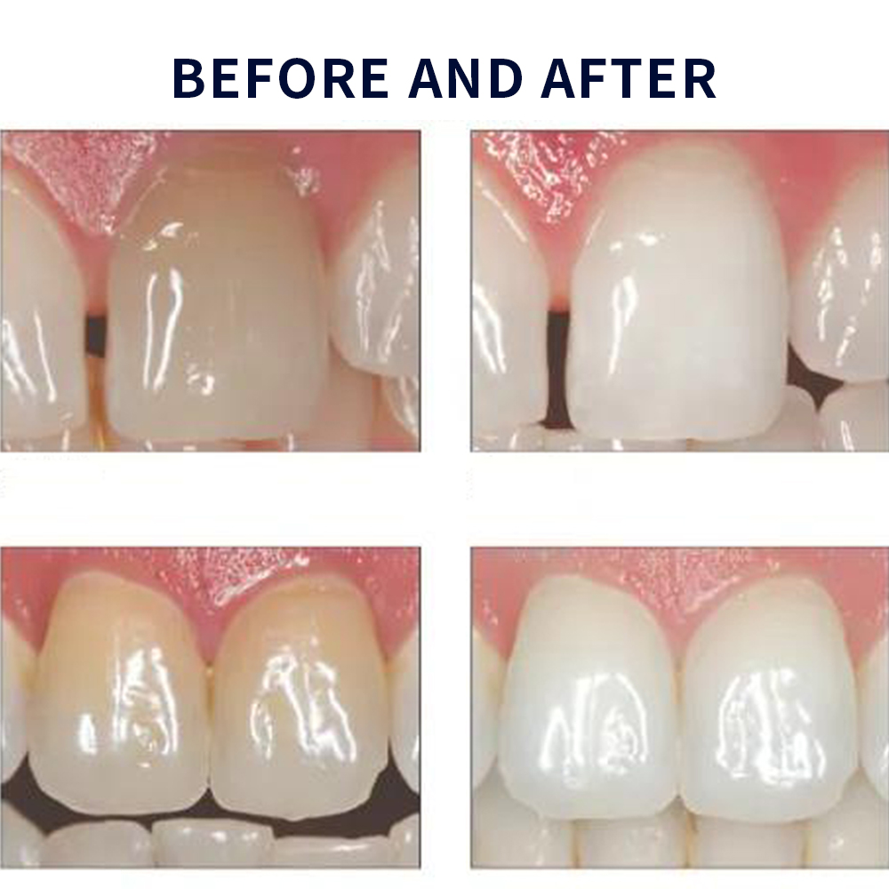 Opalescence Whitening 20% PF 2 - Teeth Whitening Gel Opalescence review and price