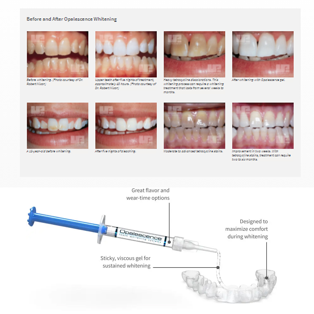 Opalescence Whitening 20% PF 2 - Teeth Whitening Gel Opalescence review and price
