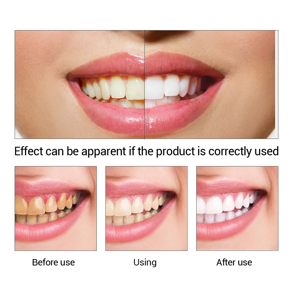 FTEENPLY Teeth Whitening Essen - Teeth Whitening China review and price