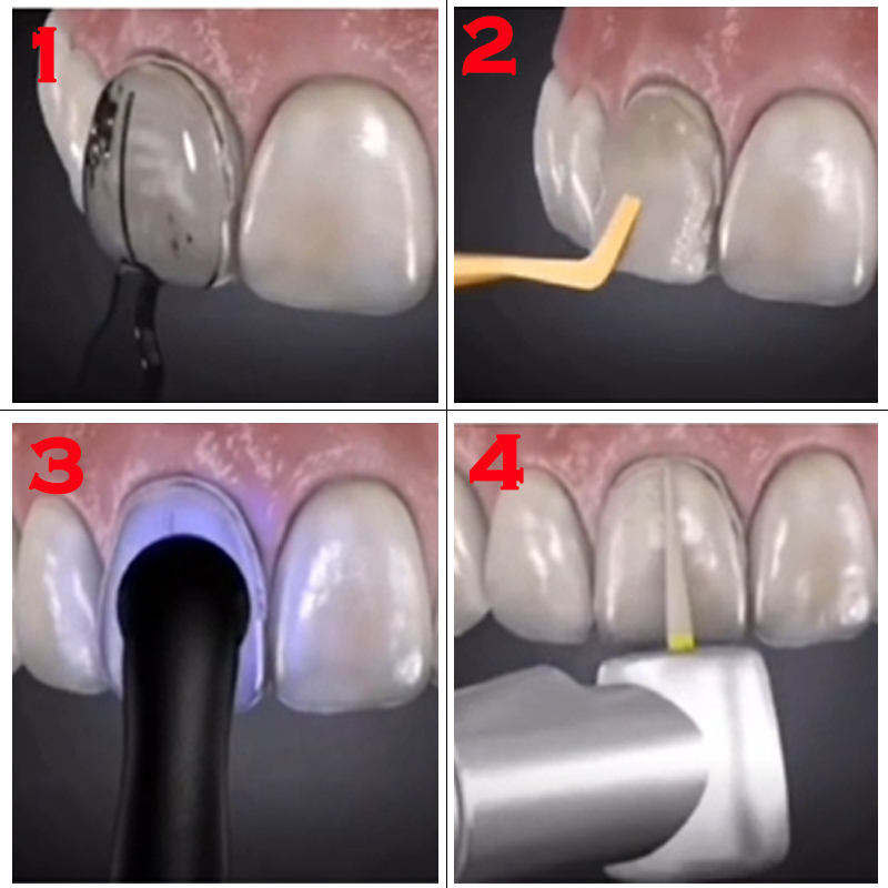 Dental Mold for Composite Resi - Teeth Whitening Veneers review and price