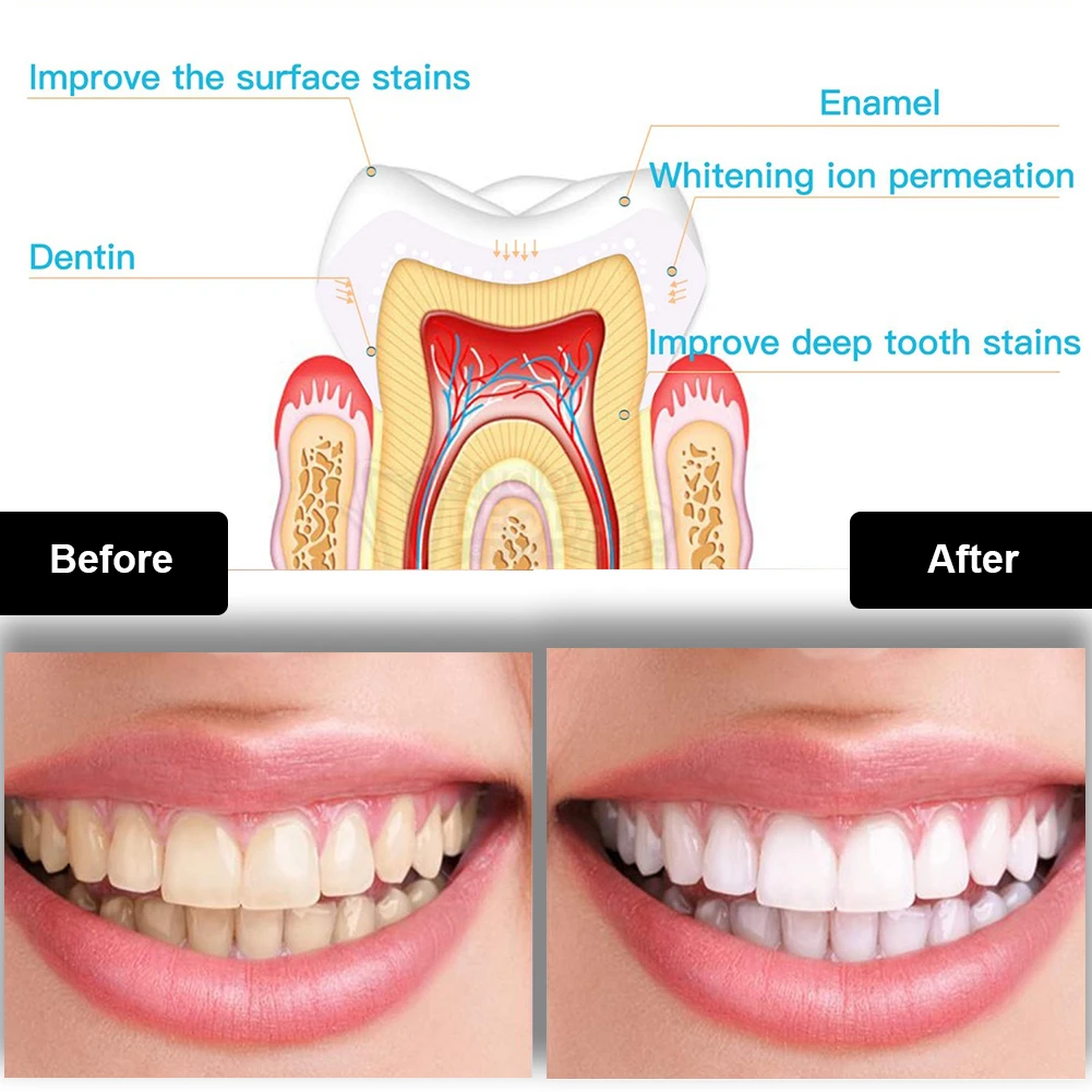 Dental Teeth Whitening Kit Min - Teeth Whitening With Blue Light review and price