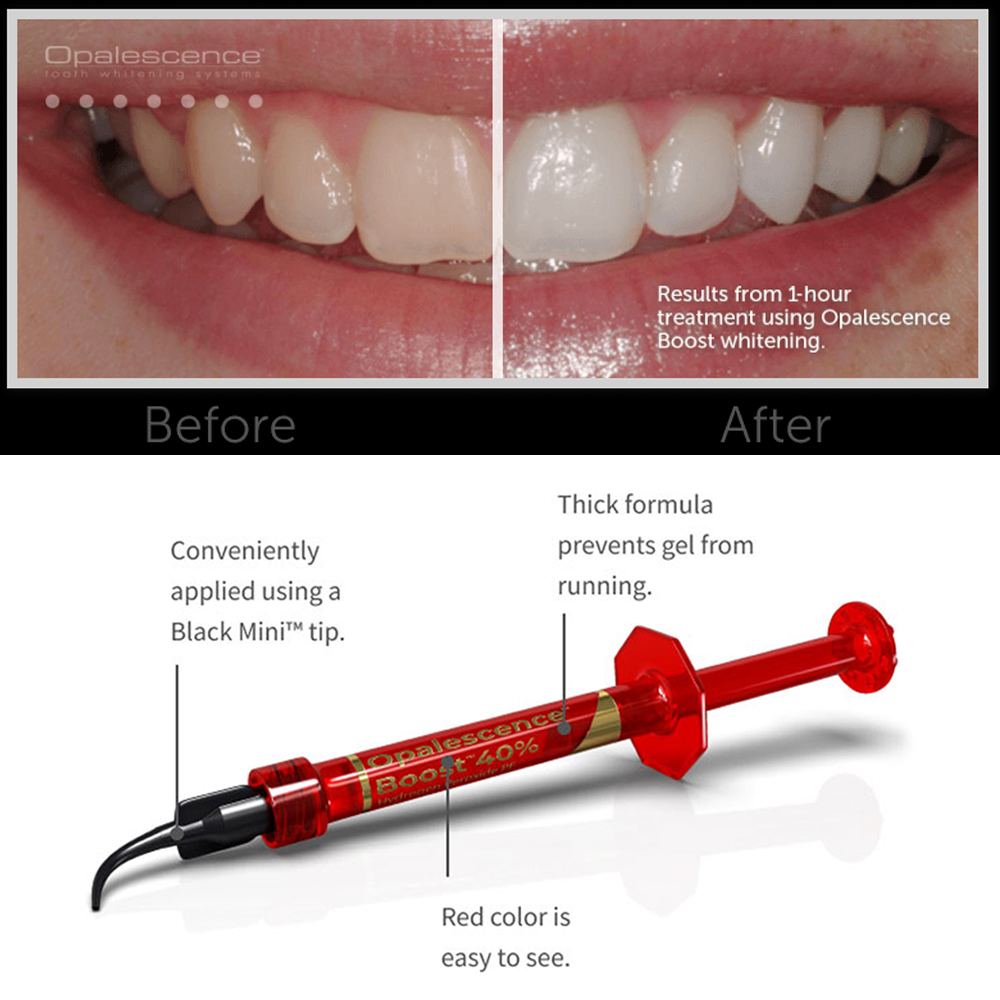 Ultradent Opalescence Boost PF - Teeth Whitening Gel Opalescence review and price
